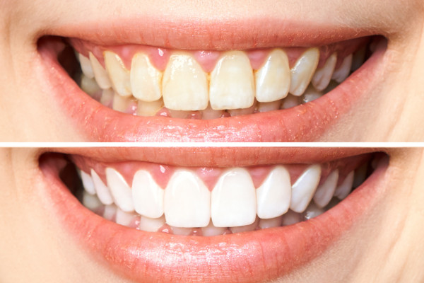 歯の黄ばみの原因は？黄ばみの改善と予防に効果的な方法を教えます