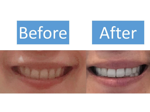 アラフォー女性のデュアルホワイトニング体験談 Smileteeth スマイルティース