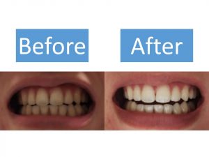 30代女性のfapホワイトニング体験談 費用をかけてもホワイトニングに投資した感想は Smileteeth スマイルティース