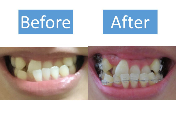 30代女性のワイヤー矯正体験談 気になっていた受け口を治すために矯正した感想は Smileteeth スマイルティース