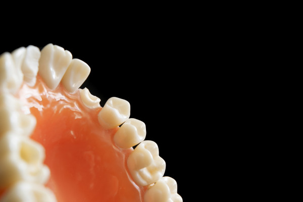 歯列矯正中に虫歯になりやすい理由
