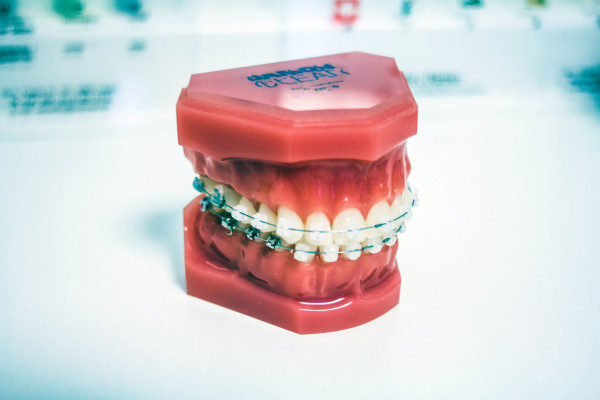 歯列矯正用のワックスとは｜器具による口内の痛みを和らげるアイテム