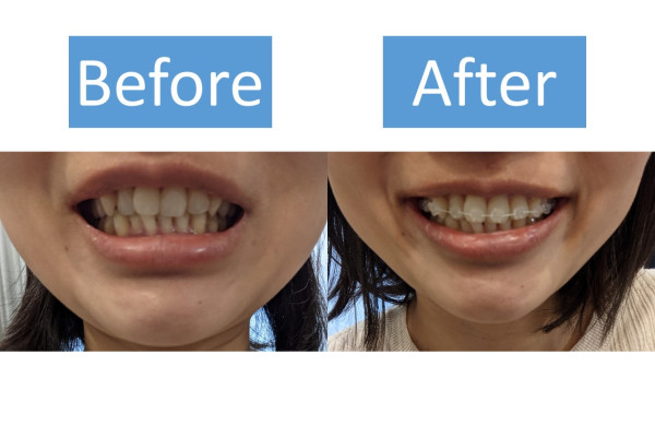女性のワイヤー矯正体験談 始めて数か月経った感想は 後悔してる Smileteeth スマイルティース
