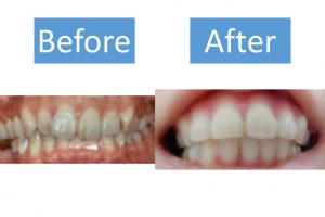 30代女性のfapホワイトニング体験談 費用をかけてもホワイトニングに投資した感想は Smileteeth スマイルティース
