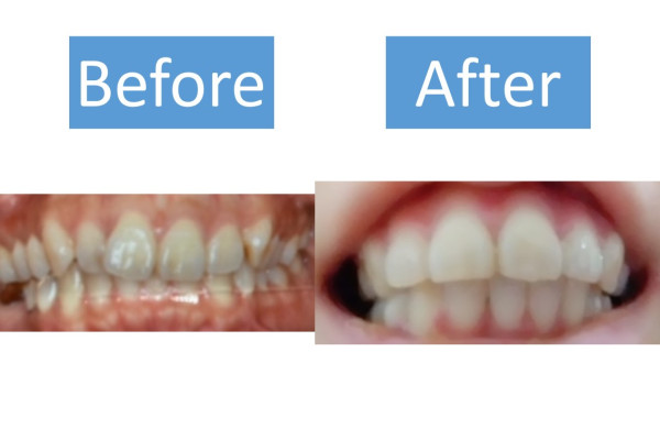 女性のワイヤー矯正体験談 笑うときに歯を手で隠していたのは改善された Smileteeth スマイルティース