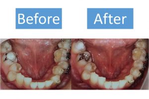 30代女性のfapホワイトニング体験談 費用をかけてもホワイトニングに投資した感想は Smileteeth スマイルティース 30代女性のfapホワイトニング体験談 費用をかけてもホワイトニングに投資した感想は Smileteeth スマイルティース