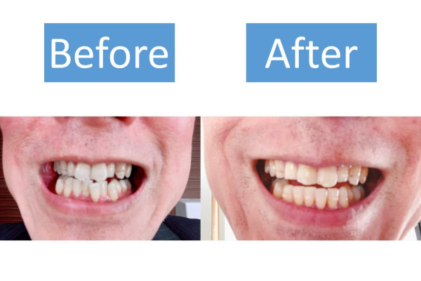 55歳男性のマウスピース矯正体験談 どれくらいで効果を実感した Smileteeth スマイルティース
